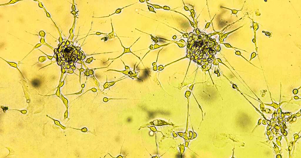 A close-up of human malignant brain tumor cells under a microscope.